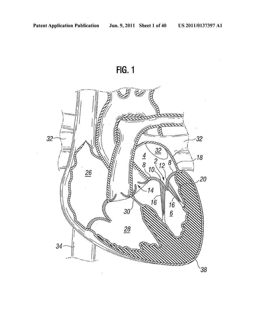 PROSTHETIC VALVE FOR REPLACING MITRAL VALVE - diagram, schematic, and image 02