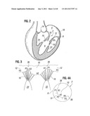 PROSTHETIC VALVE FOR REPLACING MITRAL VALVE diagram and image