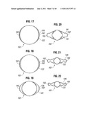 PROSTHETIC VALVE FOR REPLACING MITRAL VALVE diagram and image