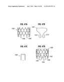 PROSTHETIC VALVE FOR REPLACING MITRAL VALVE diagram and image