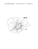 PROSTHETIC VALVE FOR REPLACING MITRAL VALVE diagram and image