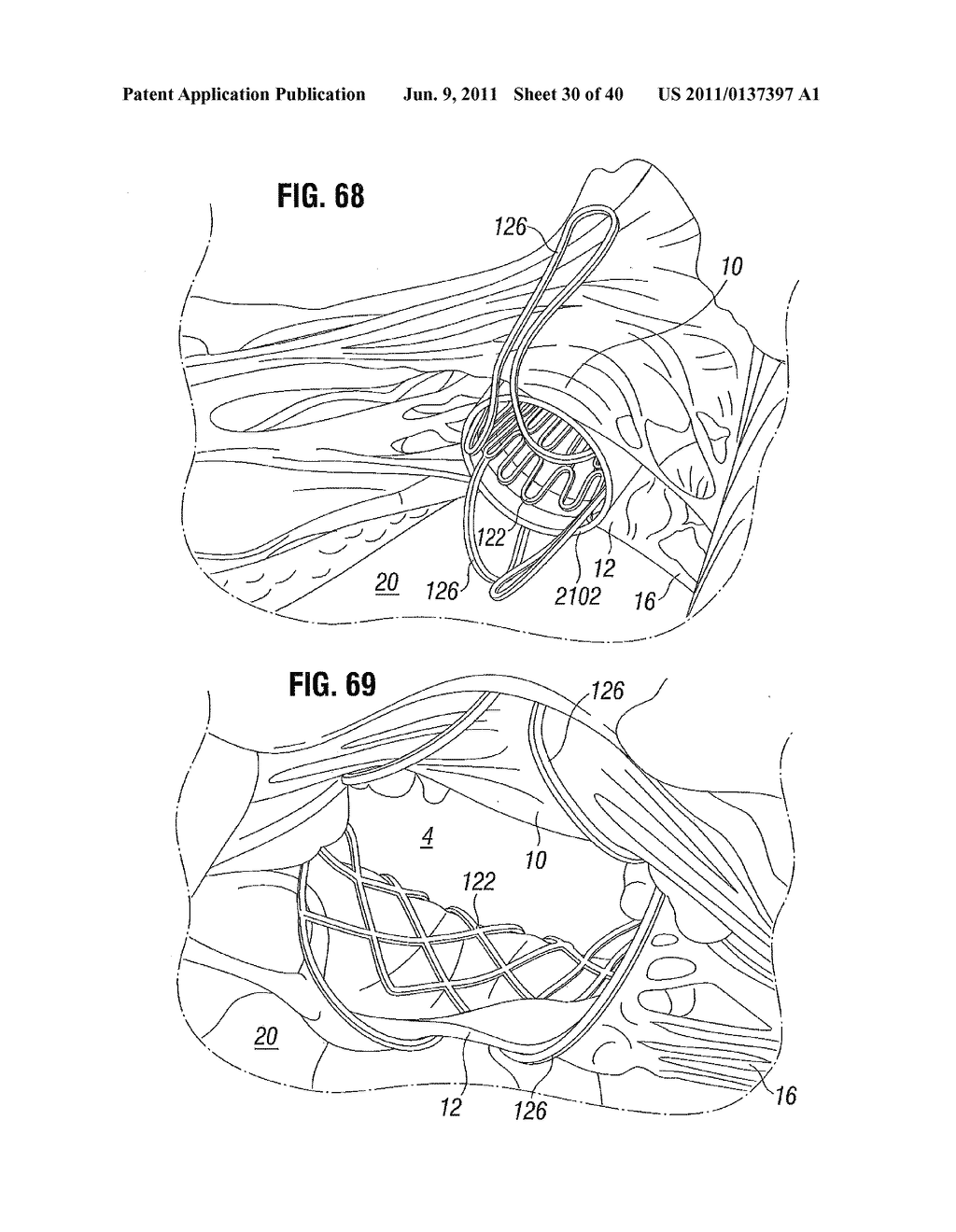 PROSTHETIC VALVE FOR REPLACING MITRAL VALVE - diagram, schematic, and image 31