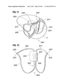 PROSTHETIC VALVE FOR REPLACING MITRAL VALVE diagram and image