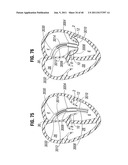 PROSTHETIC VALVE FOR REPLACING MITRAL VALVE diagram and image