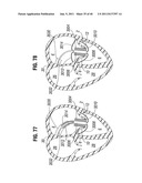 PROSTHETIC VALVE FOR REPLACING MITRAL VALVE diagram and image