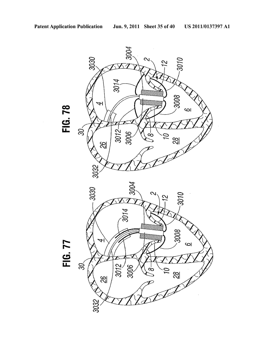 PROSTHETIC VALVE FOR REPLACING MITRAL VALVE - diagram, schematic, and image 36