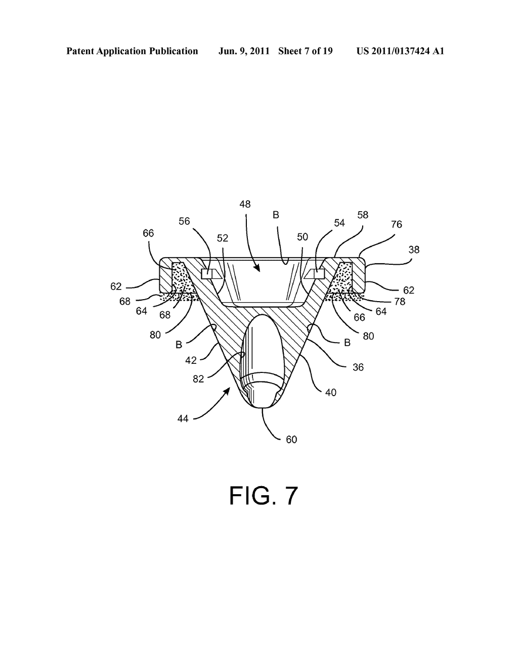 Shoulder Prosthesis Assembly having Glenoid Rim Replacement Structure - diagram, schematic, and image 08