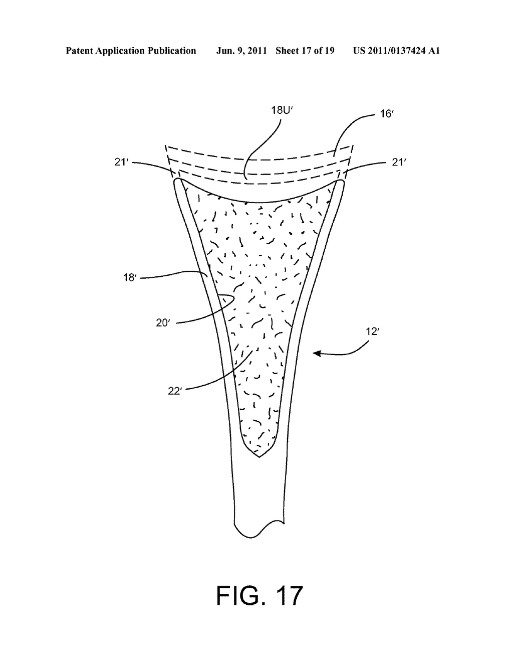 Shoulder Prosthesis Assembly having Glenoid Rim Replacement Structure - diagram, schematic, and image 18