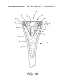 Shoulder Prosthesis Assembly having Glenoid Rim Replacement Structure diagram and image