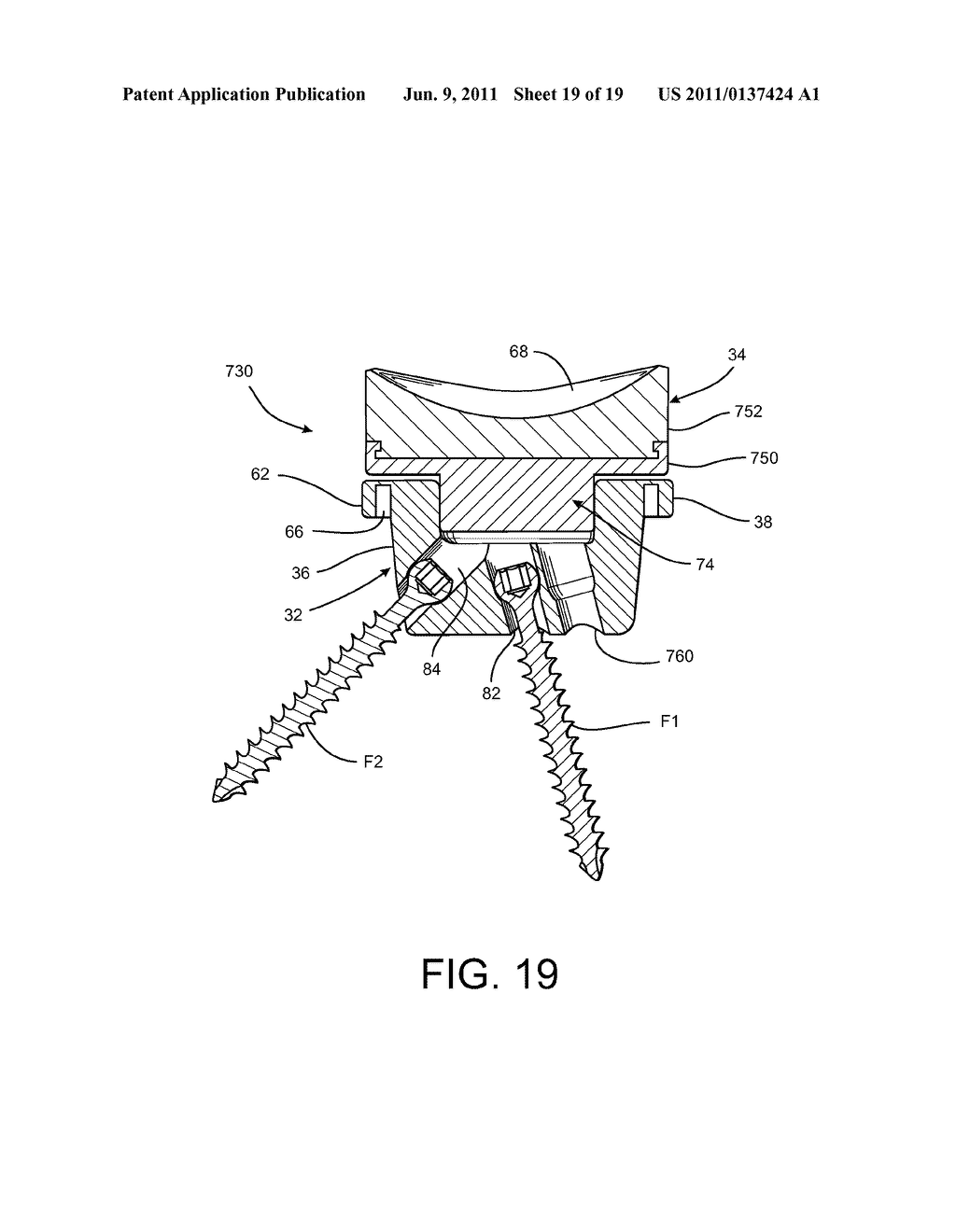 Shoulder Prosthesis Assembly having Glenoid Rim Replacement Structure - diagram, schematic, and image 20