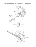 Compositions, assemblies, and methods applied during or after a dental     procedure to ameliorate fluid loss and/or promote healing, using a     hydrophilic polymer sponge structure such as chitosan diagram and image