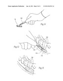 Compositions, assemblies, and methods applied during or after a dental     procedure to ameliorate fluid loss and/or promote healing, using a     hydrophilic polymer sponge structure such as chitosan diagram and image