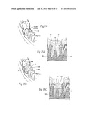 Compositions, assemblies, and methods applied during or after a dental     procedure to ameliorate fluid loss and/or promote healing, using a     hydrophilic polymer sponge structure such as chitosan diagram and image