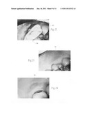 Compositions, assemblies, and methods applied during or after a dental     procedure to ameliorate fluid loss and/or promote healing, using a     hydrophilic polymer sponge structure such as chitosan diagram and image