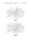 MIDDLE EAR IMPLANT AND METHOD diagram and image