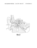 MIDDLE EAR IMPLANT AND METHOD diagram and image