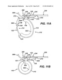 Apparatus for Completing Implantation of Gastric Band diagram and image