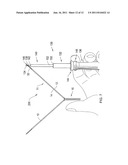 SYSTEMS, METHODS AND DEVICES RELATING TO A REMOVABLE SLEEVE FOR AN     IMPLANTABLE SLING diagram and image