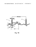 Cardiac Activation Sequence Monitoring and Tracking diagram and image