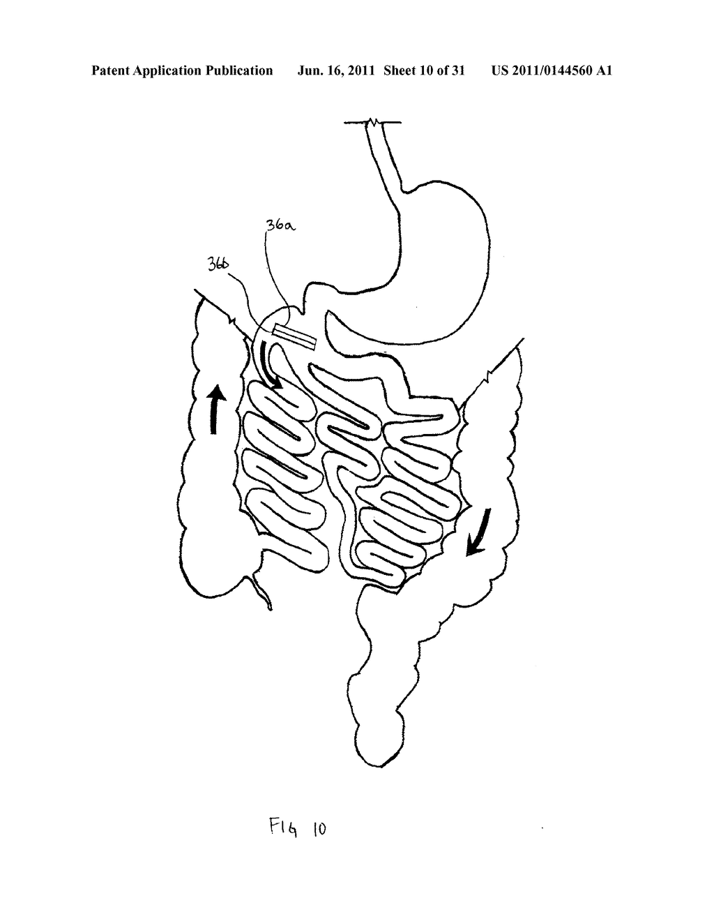 Incisionless Gastric Bypass Method And Devices - diagram, schematic, and image 11