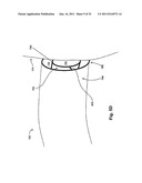 STEERING ENGAGEMENT CATHETER DEVICES, SYSTEMS, AND METHODS diagram and image