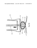 STEERING ENGAGEMENT CATHETER DEVICES, SYSTEMS, AND METHODS diagram and image