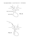 INTRAVASCULAR CATHETER WITH POSITIONING MARKERS AND METHOD OF PLACEMENT diagram and image