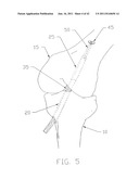 APPARATUS AND METHOD FOR RECONSTRUCTING A LIGAMENT diagram and image