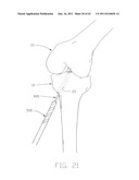 APPARATUS AND METHOD FOR RECONSTRUCTING A LIGAMENT diagram and image