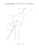 APPARATUS AND METHOD FOR RECONSTRUCTING A LIGAMENT diagram and image