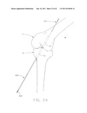 APPARATUS AND METHOD FOR RECONSTRUCTING A LIGAMENT diagram and image