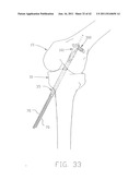 APPARATUS AND METHOD FOR RECONSTRUCTING A LIGAMENT diagram and image