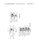 BONE FIXATION ASSEMBLY diagram and image