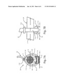 BONE FIXATION ASSEMBLY diagram and image