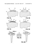 ARTIFICIAL JOINT SUPPORT BETWEEN FIRST AND SECOND BONES diagram and image