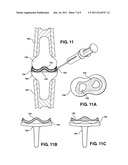 ARTIFICIAL JOINT SUPPORT BETWEEN FIRST AND SECOND BONES diagram and image