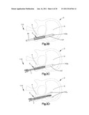 Allograft Bone Plugs, Systems and Techniques diagram and image