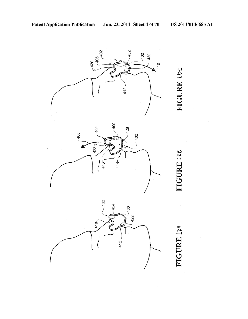 PATIENT  INTERFACE AND ASPECTS THEREOF - diagram, schematic, and image 05