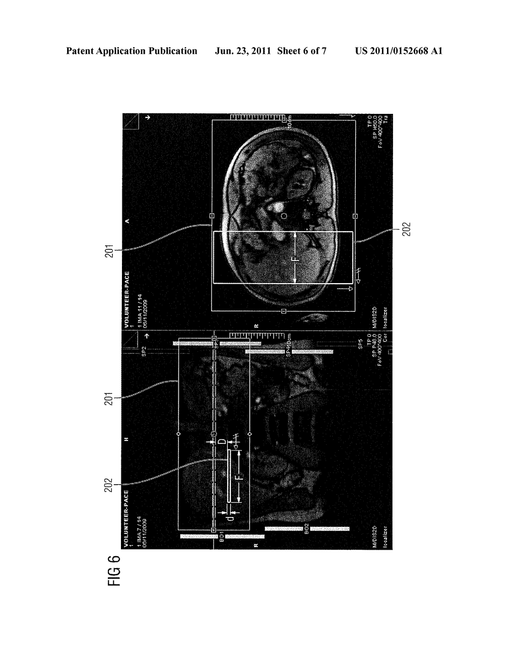 METHOD TO DETECT A BREATHING MOVEMENT OF AN EXAMINATION SUBJECT     CORRESPONDING TO SIGNAL DATA BY MAGNETIC RESONANCE - diagram, schematic, and image 07