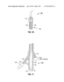 Illuminating Balloon Catheter and Method for Using the Catheter diagram and image