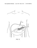 SURGICAL INSTRUMENT COMPRISING AN ELECTRODE diagram and image