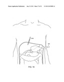 SURGICAL INSTRUMENT COMPRISING AN ELECTRODE diagram and image