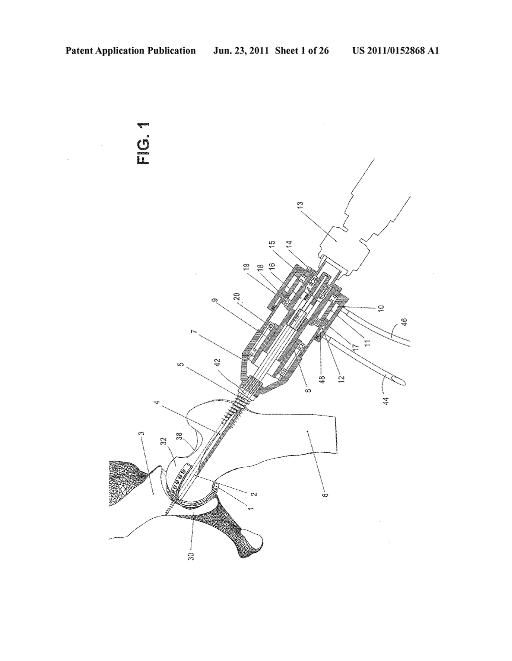 METHOD, DEVICE, AND SYSTEM FOR SHAVING AND SHAPING OF A JOINT - diagram, schematic, and image 02