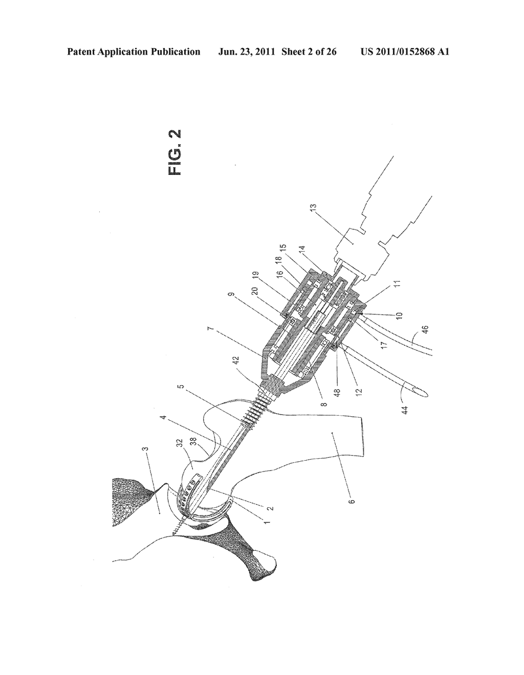 METHOD, DEVICE, AND SYSTEM FOR SHAVING AND SHAPING OF A JOINT - diagram, schematic, and image 03