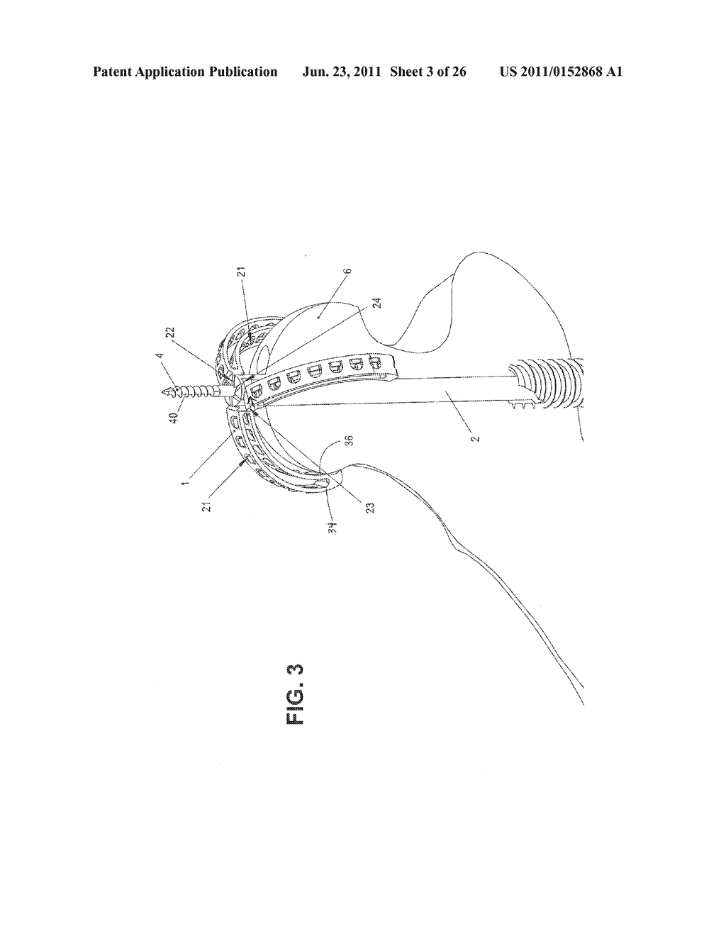 METHOD, DEVICE, AND SYSTEM FOR SHAVING AND SHAPING OF A JOINT - diagram, schematic, and image 04