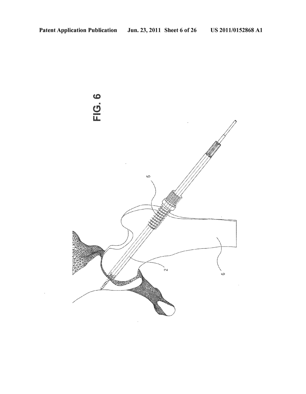METHOD, DEVICE, AND SYSTEM FOR SHAVING AND SHAPING OF A JOINT - diagram, schematic, and image 07