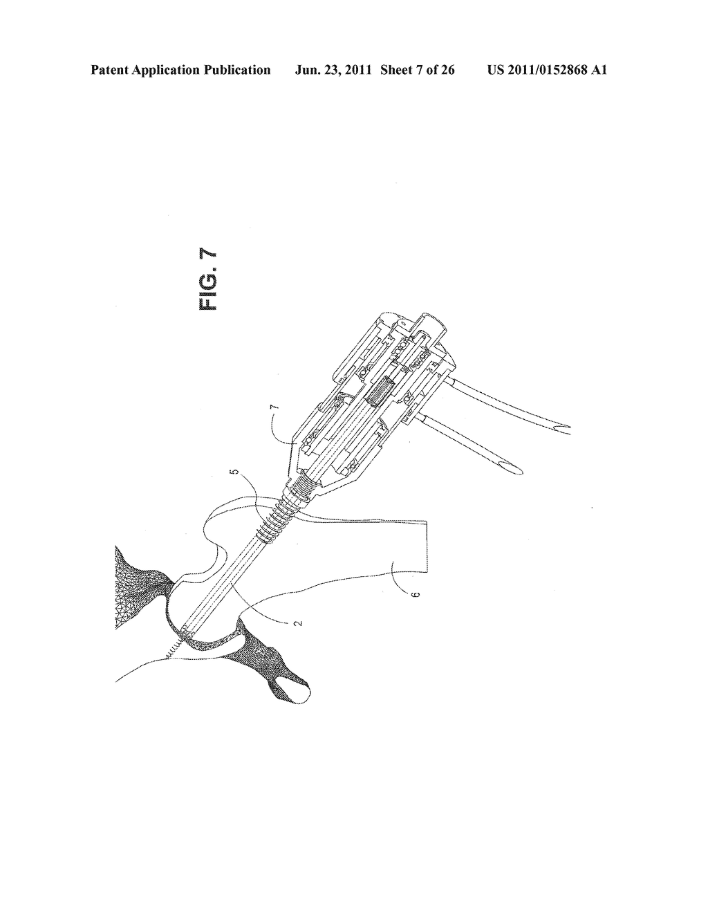 METHOD, DEVICE, AND SYSTEM FOR SHAVING AND SHAPING OF A JOINT - diagram, schematic, and image 08