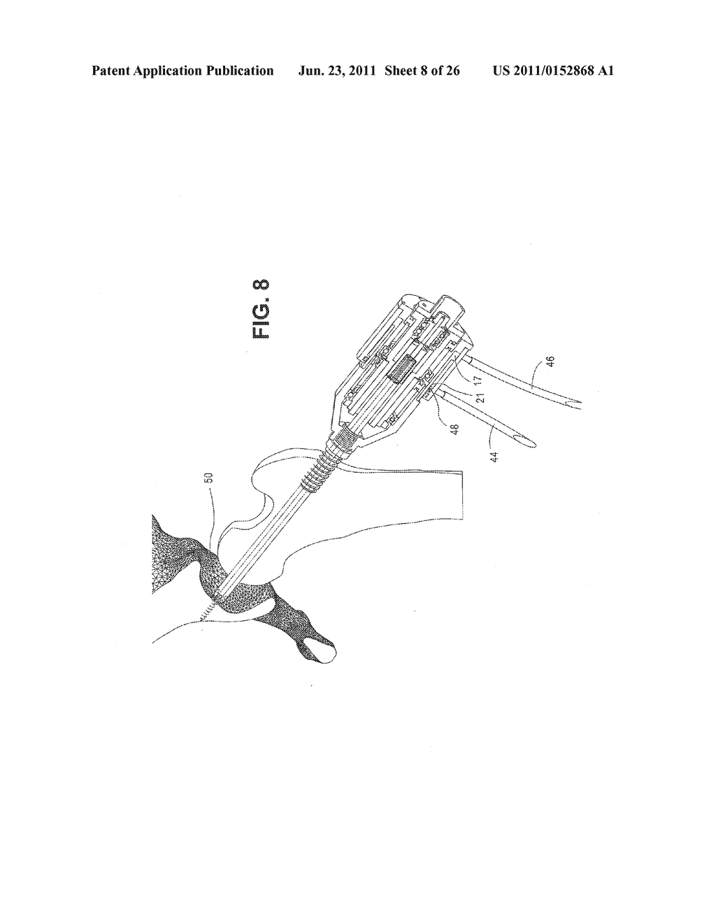 METHOD, DEVICE, AND SYSTEM FOR SHAVING AND SHAPING OF A JOINT - diagram, schematic, and image 09