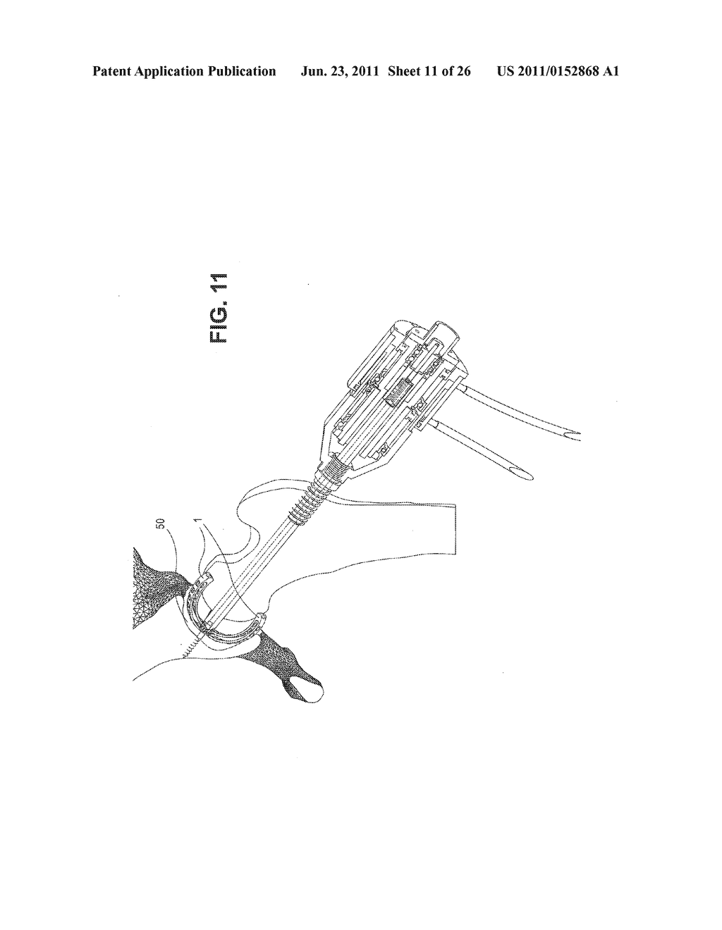 METHOD, DEVICE, AND SYSTEM FOR SHAVING AND SHAPING OF A JOINT - diagram, schematic, and image 12