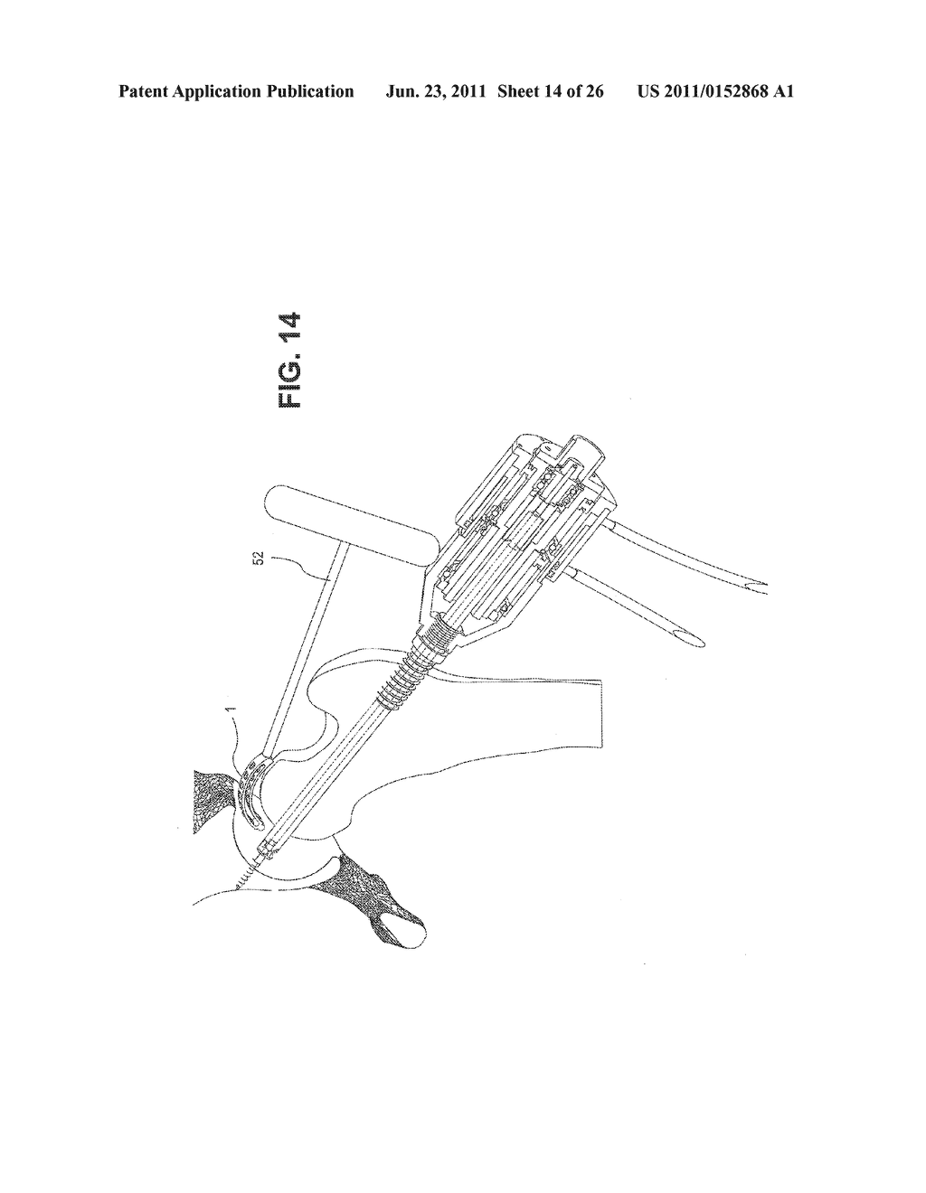 METHOD, DEVICE, AND SYSTEM FOR SHAVING AND SHAPING OF A JOINT - diagram, schematic, and image 15